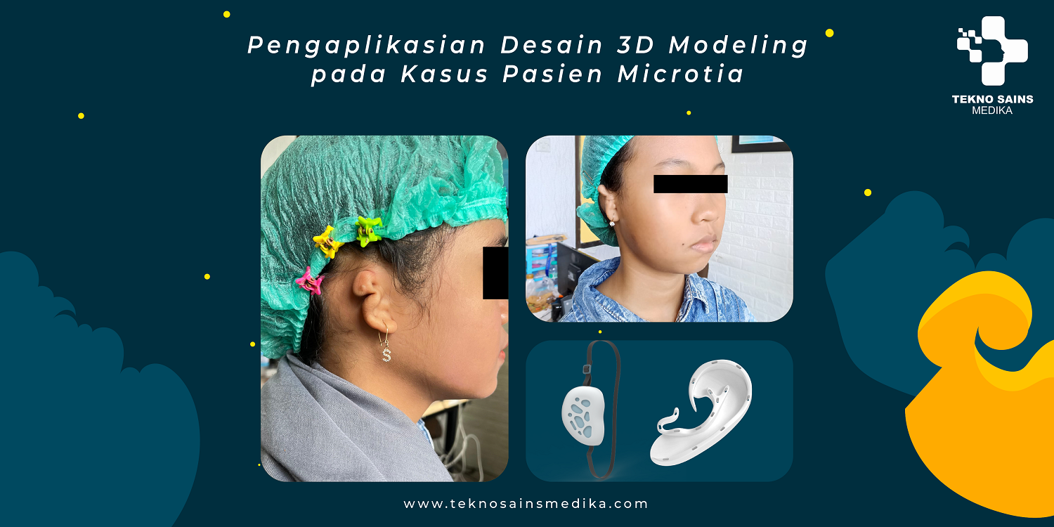 3D modeling kesehatan microtia