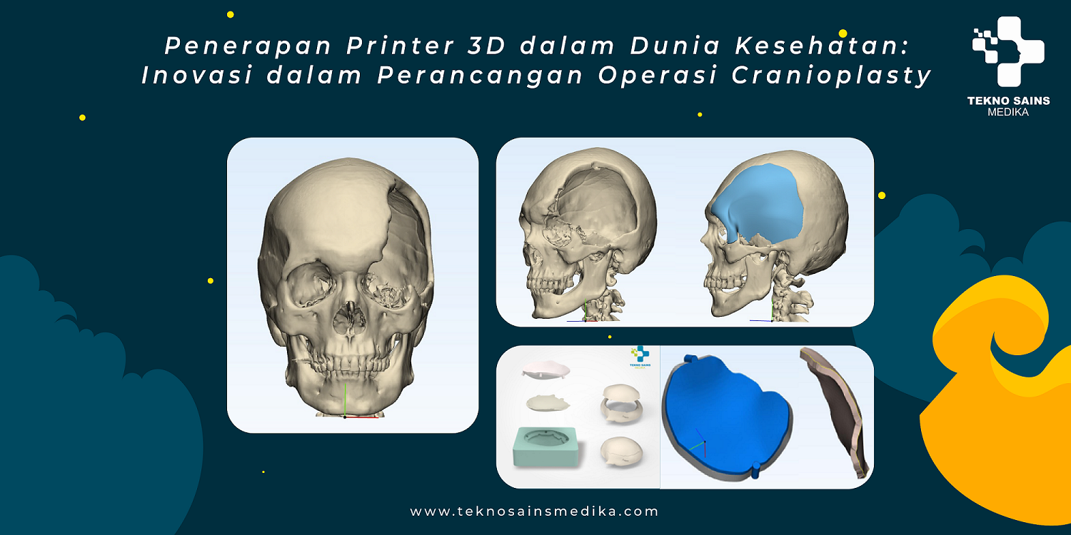 bedah cranioplasty 3D kesehatan