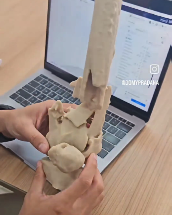 3D Printing for Ortho Surgery by Tekno Sains Medika 2