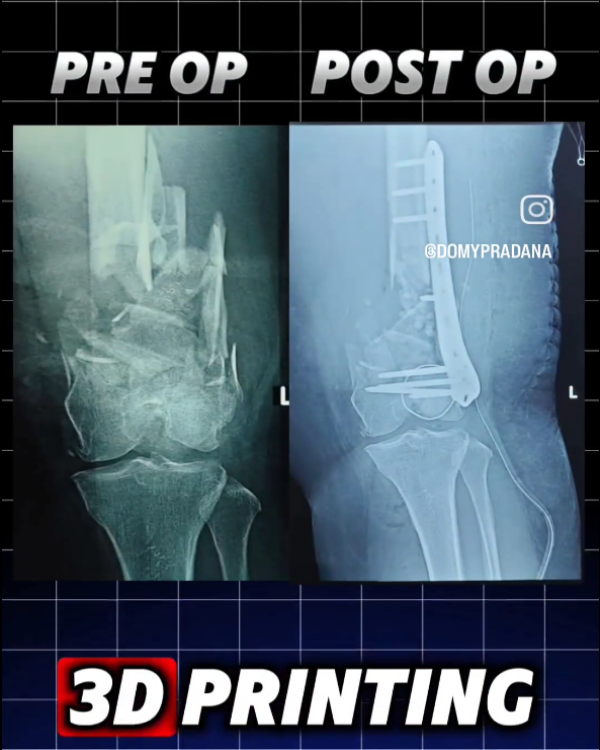 3D Printing for Ortho Surgery by Tekno Sains Medika 6